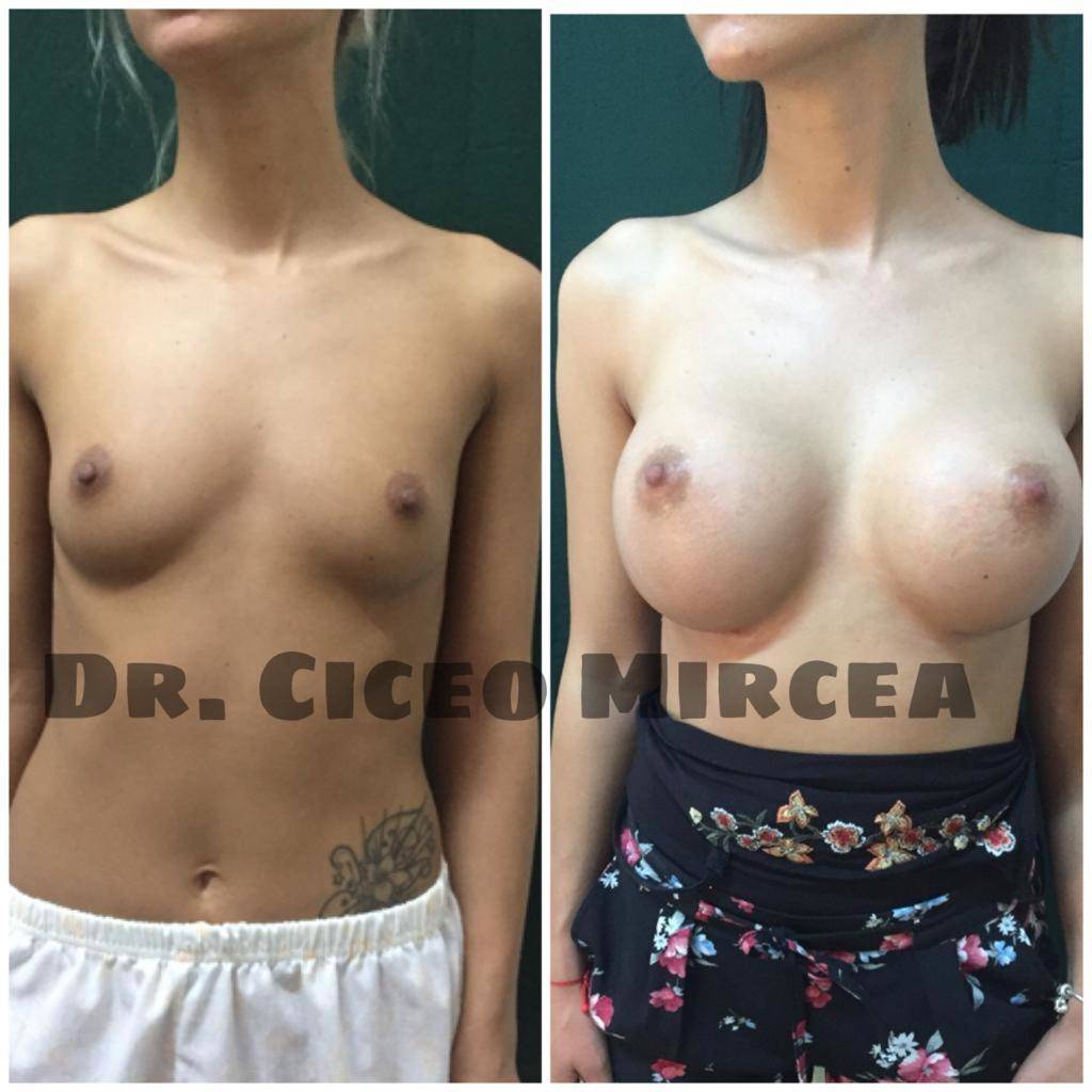 implanturi mamare Cluj, silicoane pret clinica Medestet