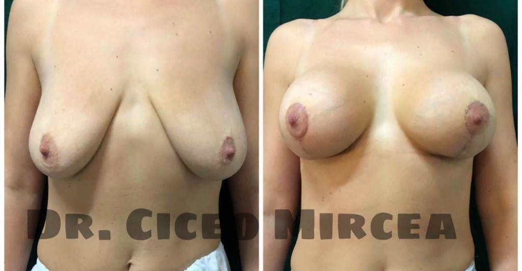 masteopexie Cluj, reductie mamara