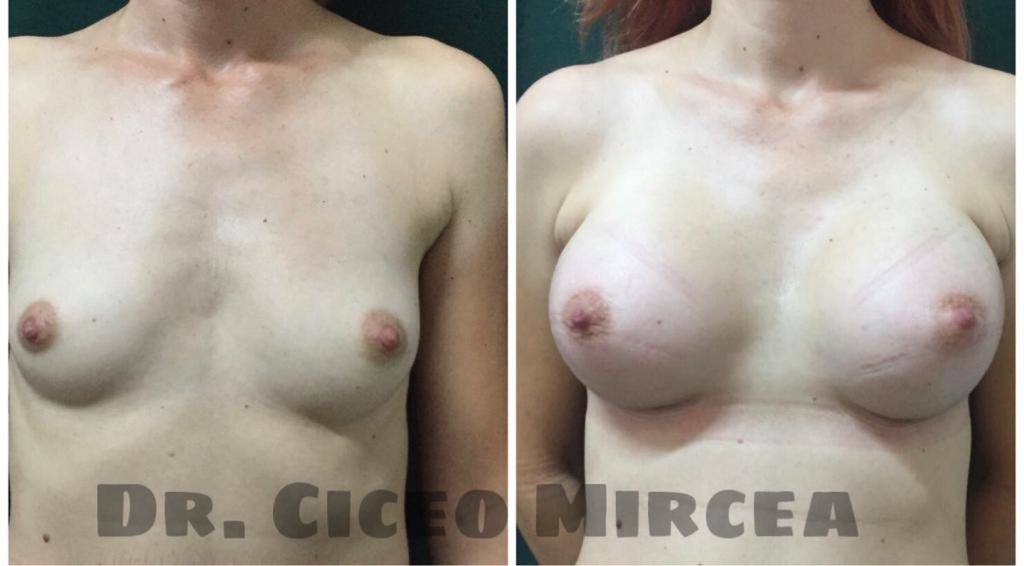 implante mamare Medestet