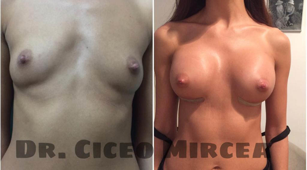implant silicoane Cluj, clinica chirurgie estetica Medestet