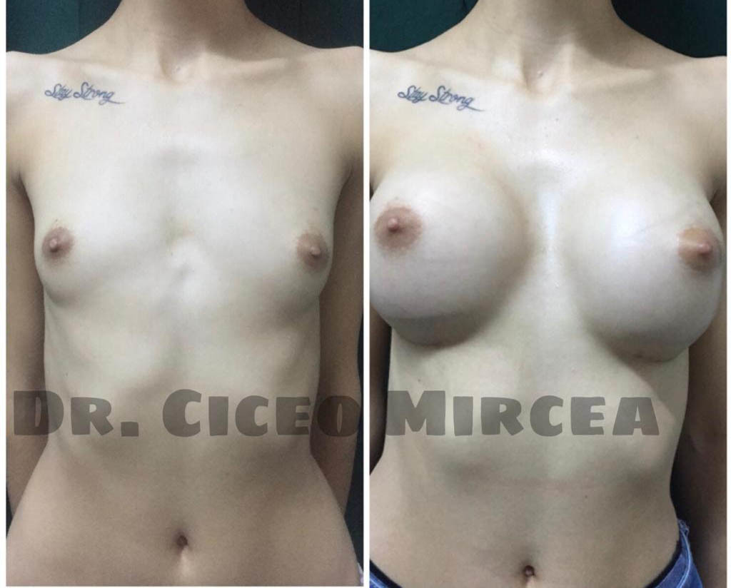implant mamar Cluj, silicoane Cluj, clinica chirurgie estetica MEdestet