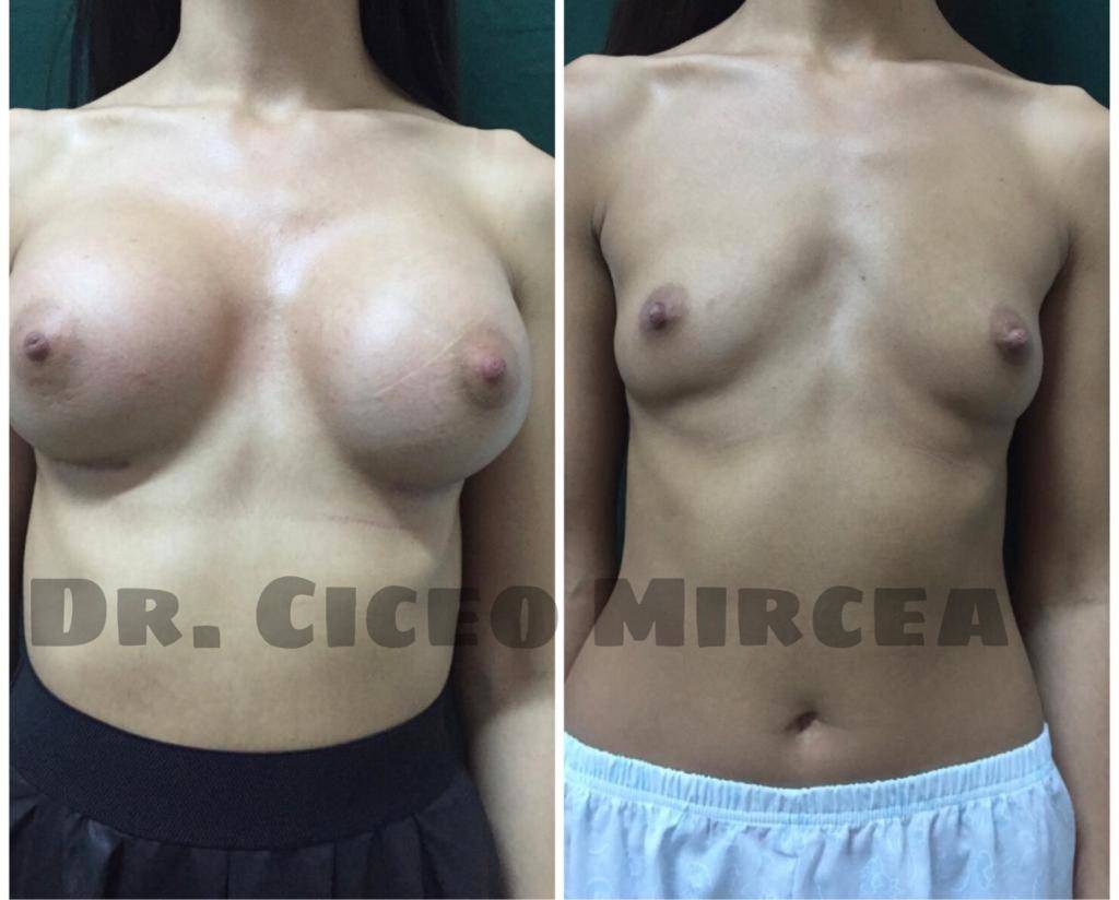 implant mamar Cluj, silicoane Cluj, clinica chirurgie estetica MEdestet