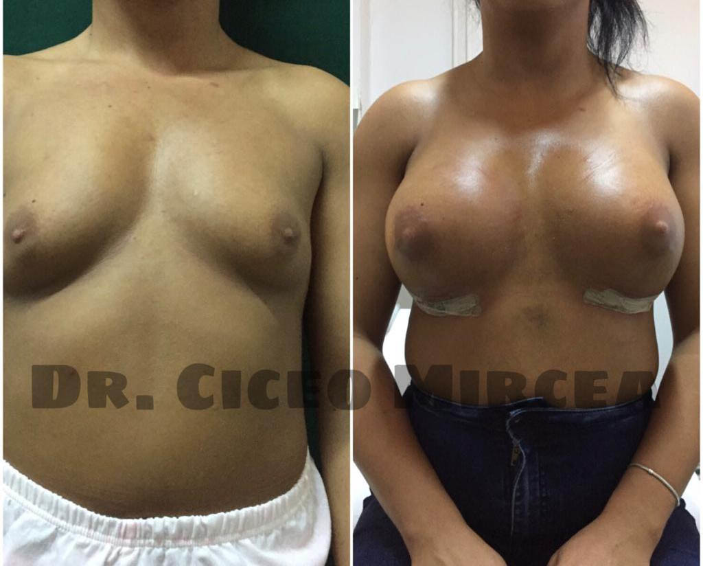 implant mamar Cluj, silicoane Cluj, clinica chirurgie estetica MEdestet