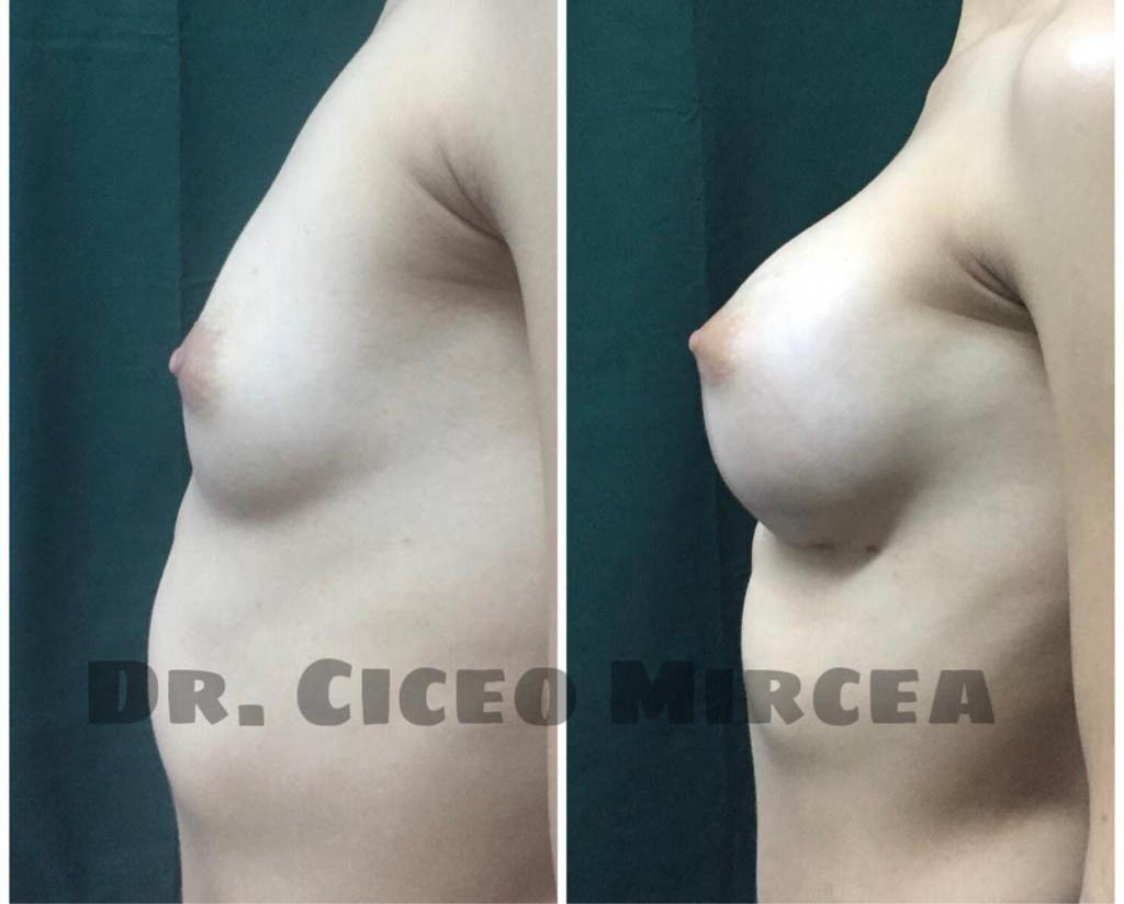 implant mamar Cluj, silicoane Cluj, clinica chirurgie estetica MEdestet