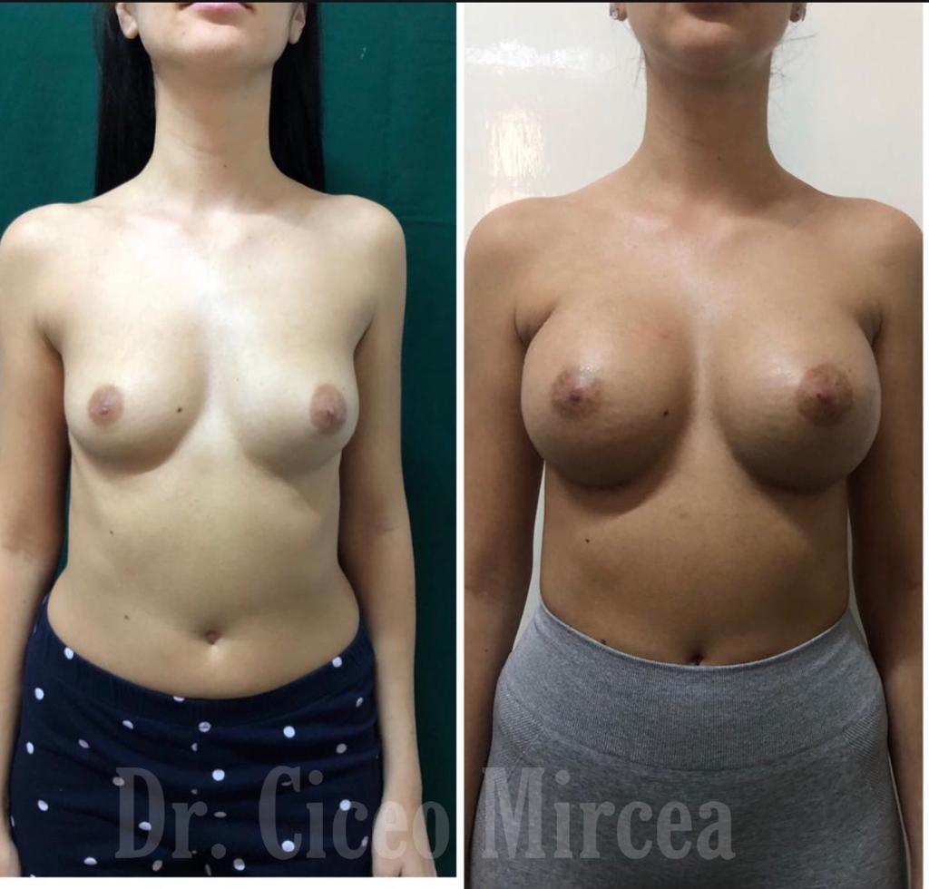 marire sani, implante mamare, silicoane Cluj, clinica chirurgie estetica MEdestet, dr Mircea Ciceo