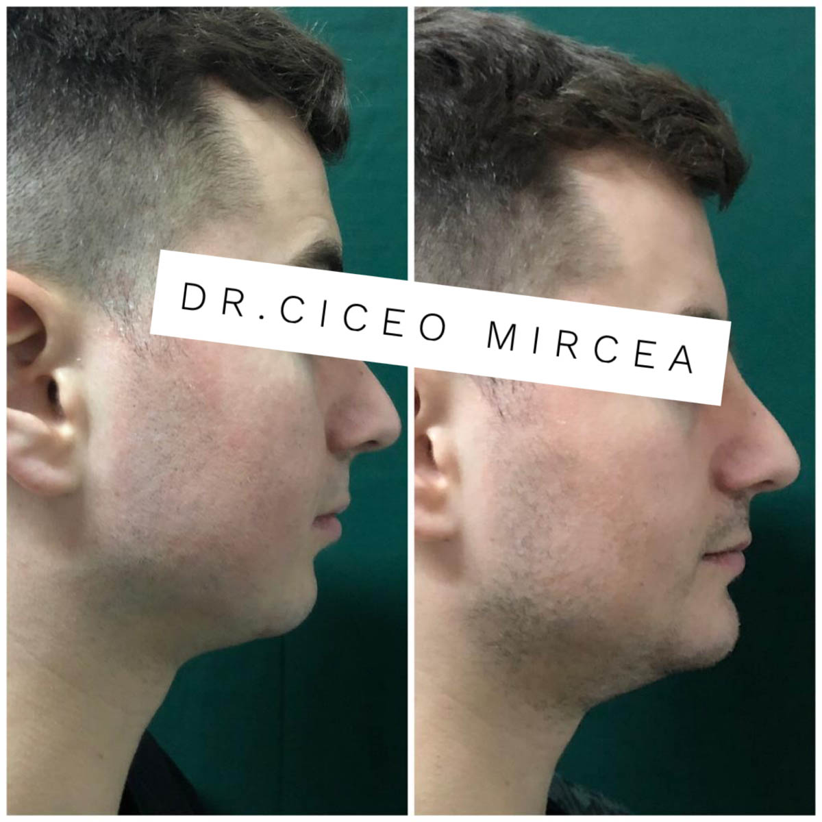 corectarea barbiei Cluj, clinica chirurgie estetica Medestet, dr Mircea Ciceo