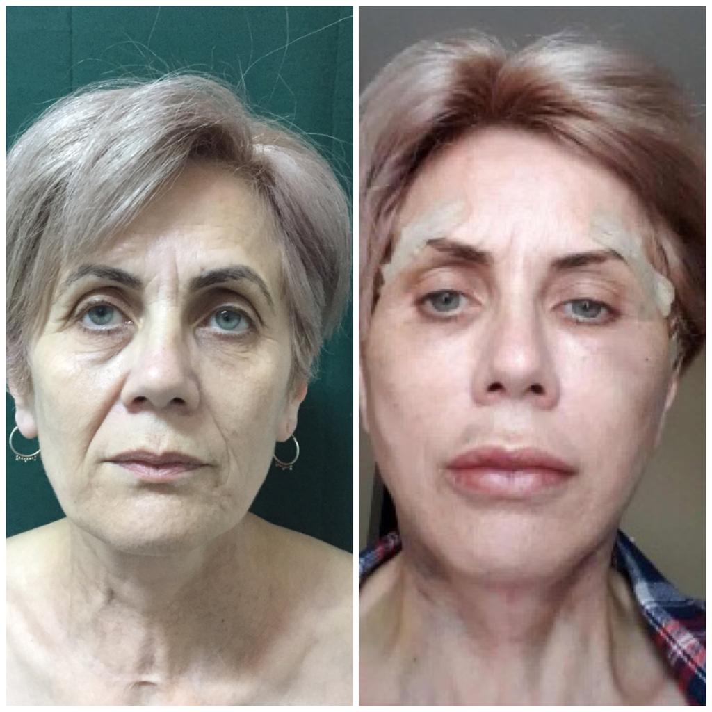 lifting facial Cluj - chirurgie estetica @ Medestet