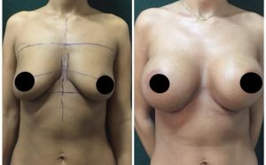 implanturi mamare Cluj, silicoane pret clinica Medestet