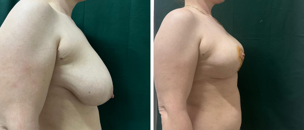 Micsorare sani Cluj – imagine inainte si dupa pentru pacientul 4