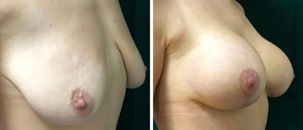 Reductie mamara – imagine inainte si dupa procedura pentru pacientul 1