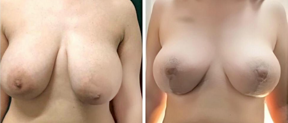 eductie mamara – rezultate inainte si dupa pentru pacientul 2