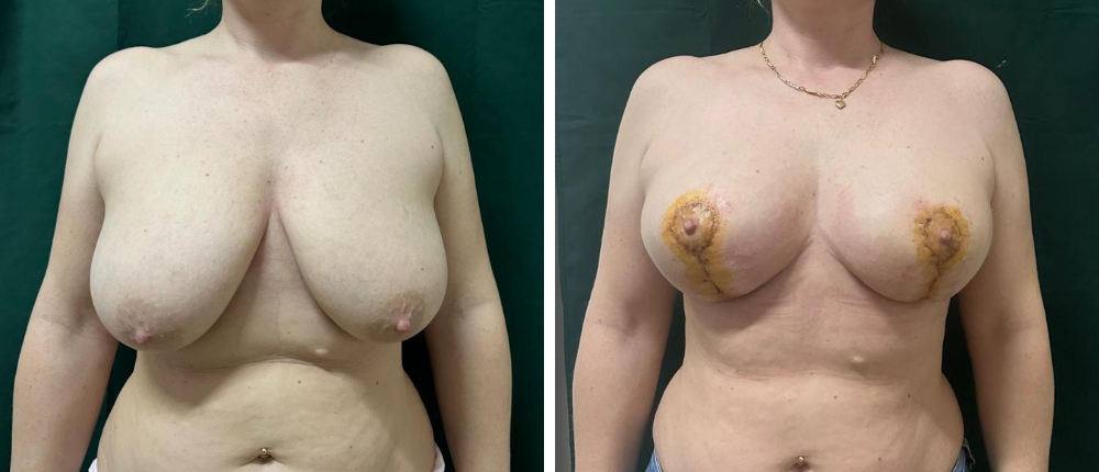 Reductie mamara – comparatie inainte si dupa procedura pentru pacientul 3