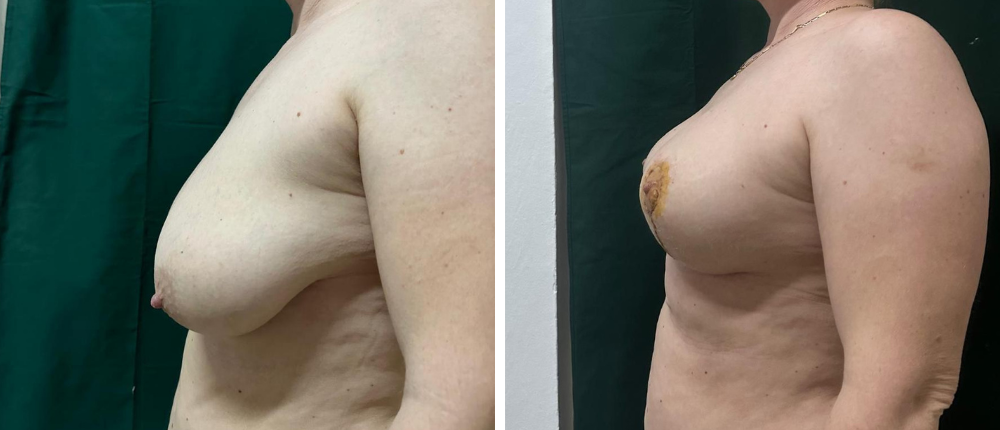 Reductie mamara Cluj – imagine inainte si dupa pentru pacientul 4